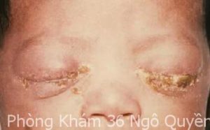 hinh-anh-benh-lau-mat-o-tre-so-sinh
