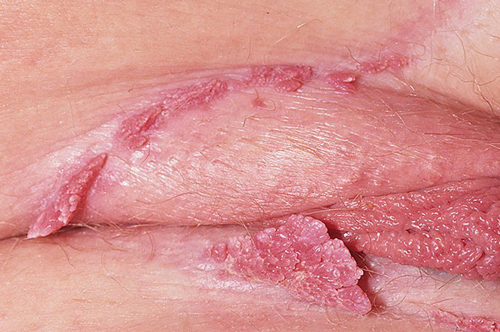 hình ảnh bệnh sùi mào gà ở phụ nữ giai đoạn nặng